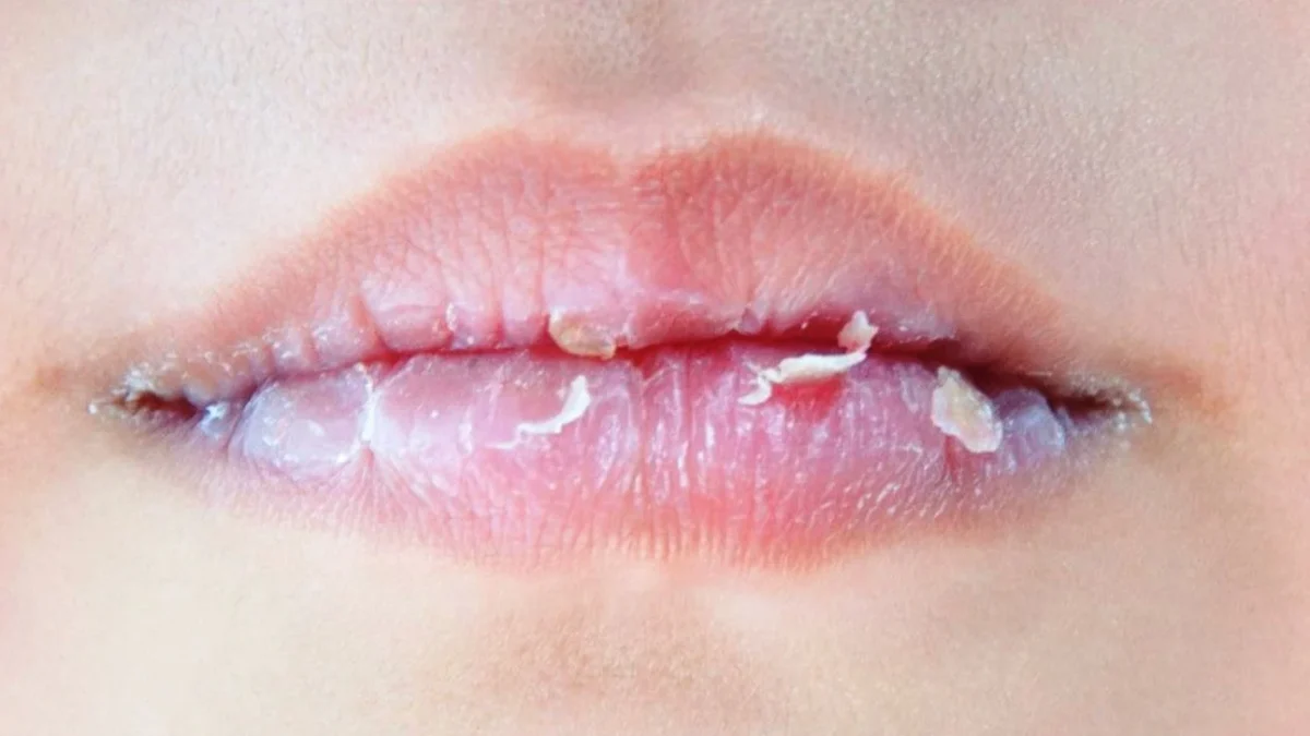 8 Tips Mengatasi Bibir Kering dan Mengelupas secara Alami, Mudah Dilakukan