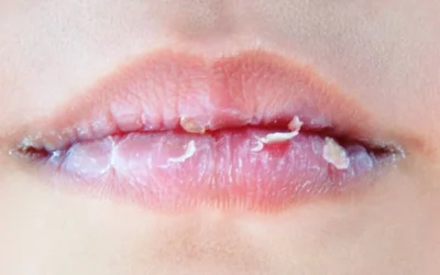 8 Tips Mengatasi Bibir Kering dan Mengelupas secara Alami, Mudah Dilakukan
