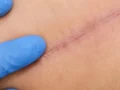 Waspada Infeksi Luka Operasi Setelah Pulang dari Rumah Sakit